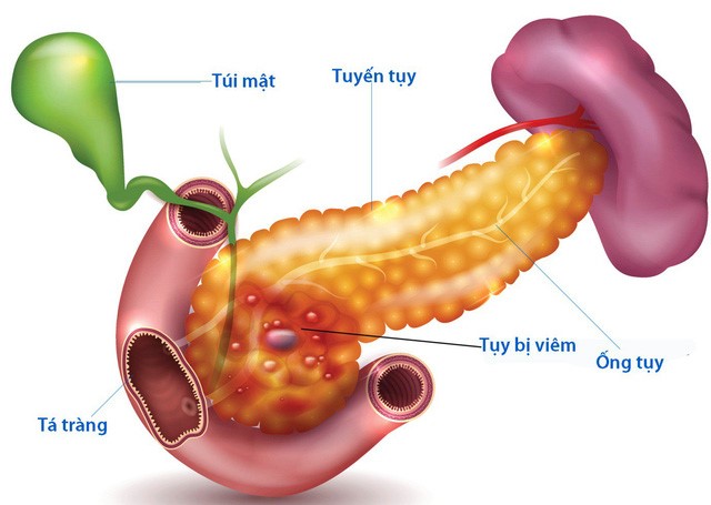 MỘT SỐ DẤU HIỆU NHẬN BIẾT VỀ VIÊM TỤY CẤP